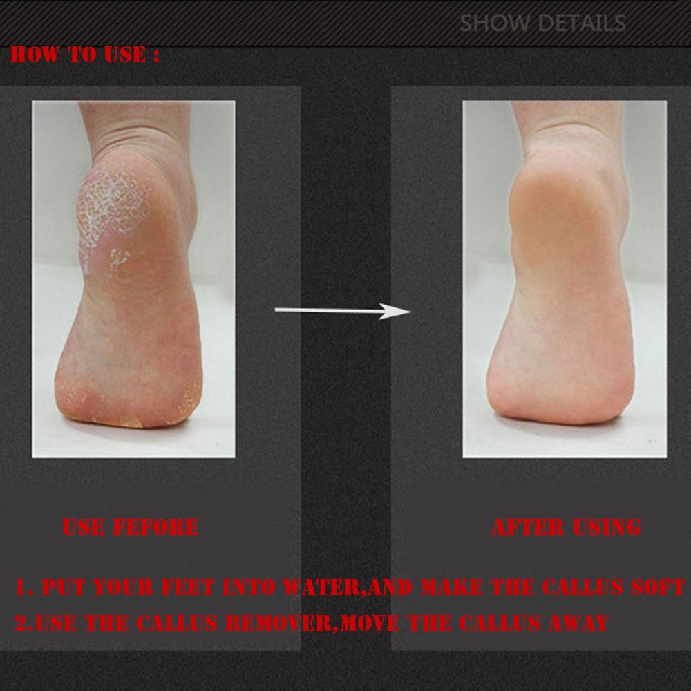 Coopsion Stainless Steel Foot File and Callus Remover - Double-Side Grinding(Silver)